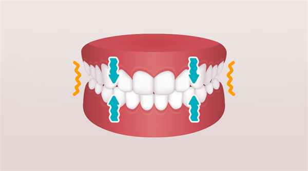 Как бруксизм воздействует на зубы