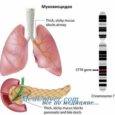 генетика муковисцидоза