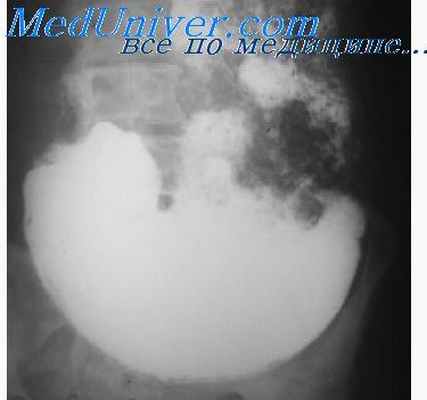 эндофитный рак желудка