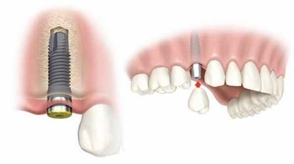 удаление зуба с имплантацией