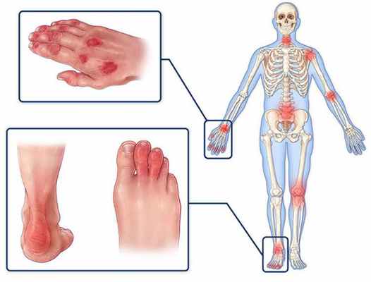 Псориаз суставов: возможные причины, симптомы с фото, методы диагностики и терапия
