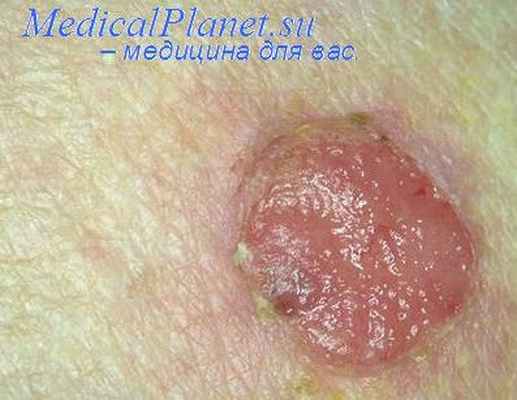 эккринная порома