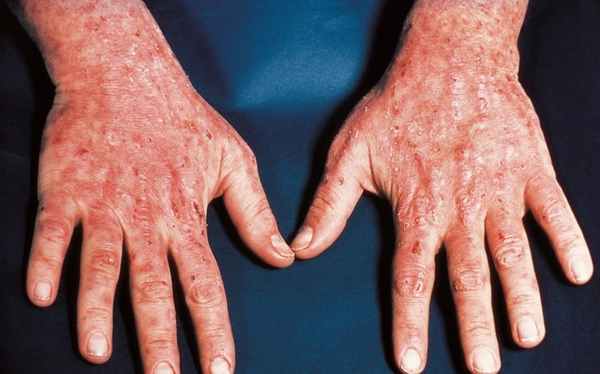 Симптомы порфирии