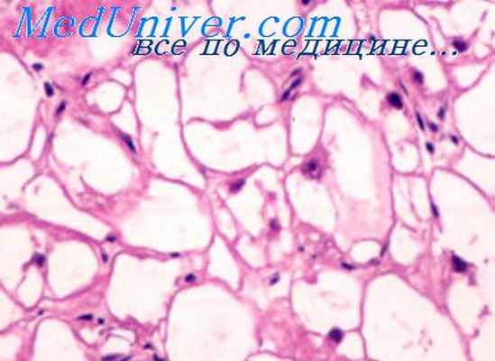 рабдомиосаркомы