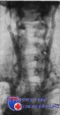 позвоночные артерии