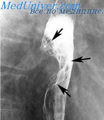 снятие спазма пищевода