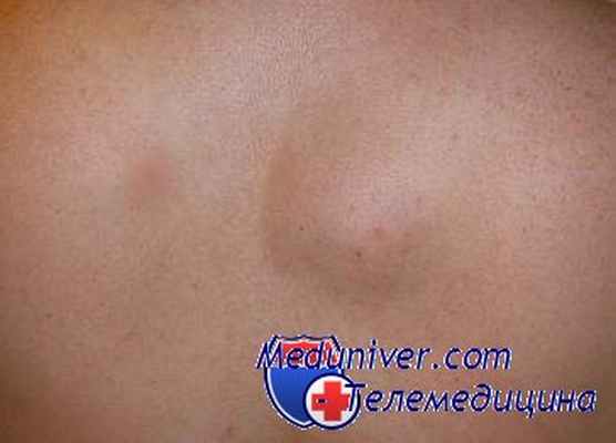 соединительнотканные невусы