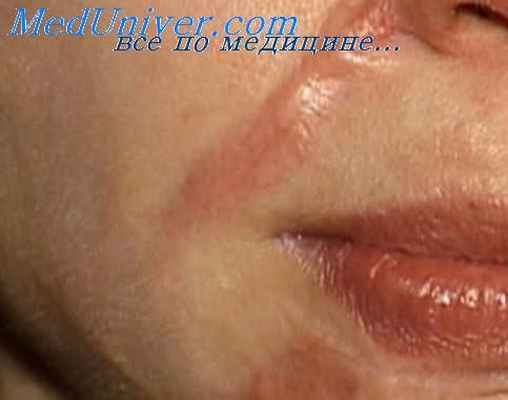 дерматофиброз