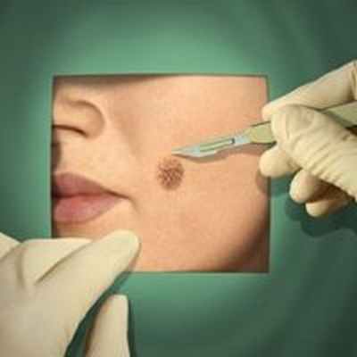 Биопсия кожи