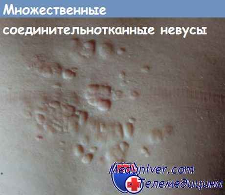 соединительнотканные невусы