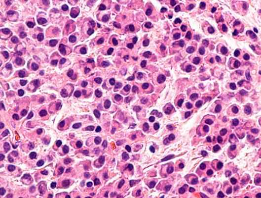 Плазмоцитома (Миеломная болезнь)