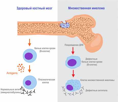 Генерализованная плазмоцитома.jpg