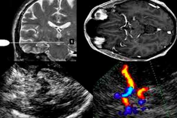 Что видит врач на экране при УЗИ сосудов головного мозга