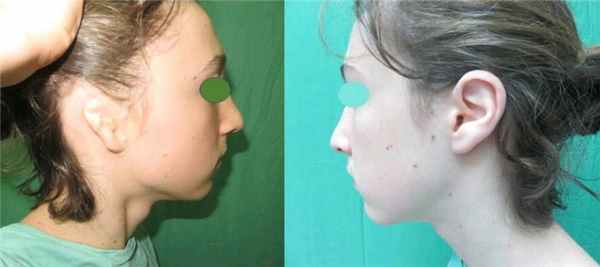 лечение микротии в Израиле в клинике сорока