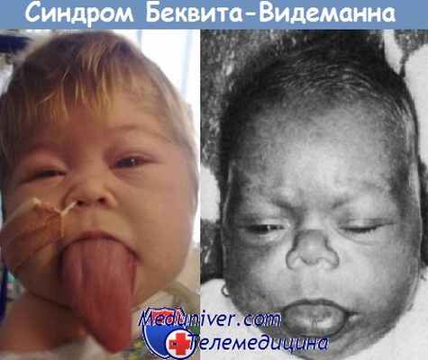 Синдром Беквита-Видеманна