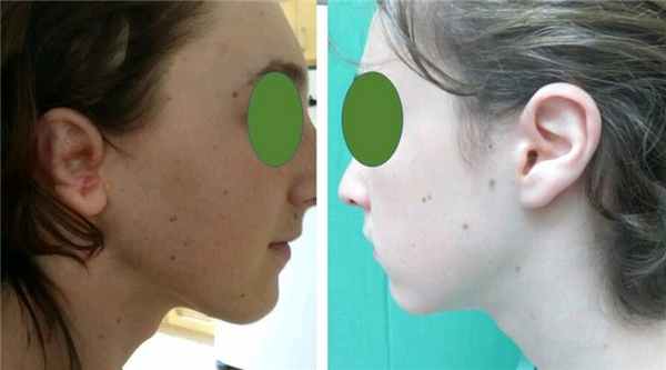 лечение микротии за границей