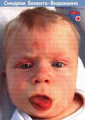 Синдром Беквита-Видеманна