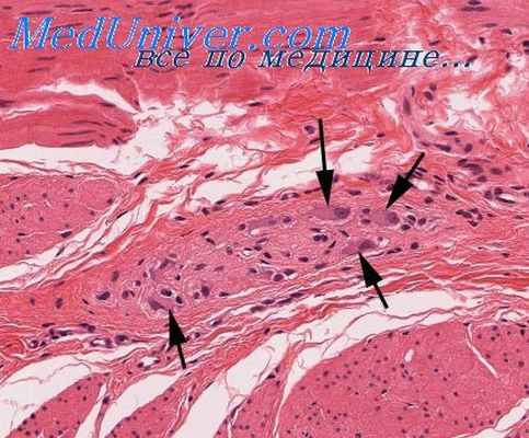 тетрада фалло