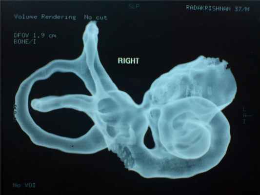 normal-rt-inner-ear3.JPG
