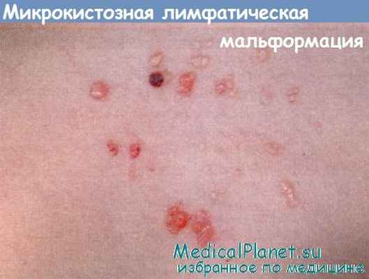 Микрокистозная лимфатическая мальформация