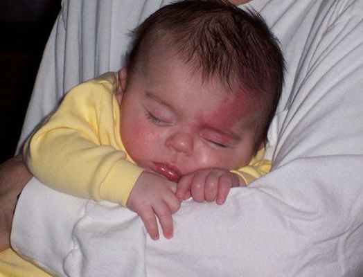 Капиллярная мальформация при синдроме Штурге — Вебера