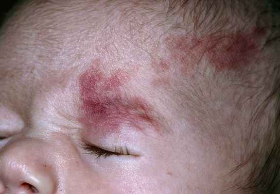 Винное пятно