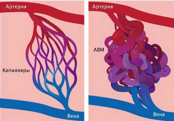 Артериовенозная мальформация