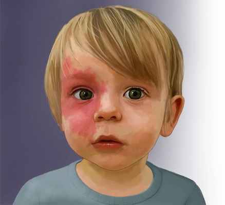 Капиллярная мальформация