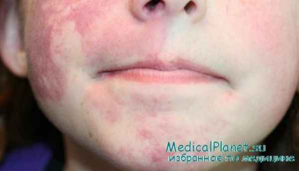 винное пятно