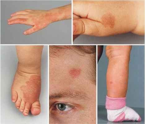 Варианты локализации капиллярной мальформации