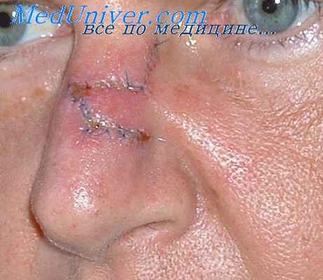 операция при опухолях носа