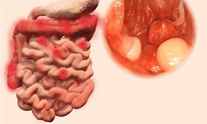 гиперпластические полипы желудка сроки удаления