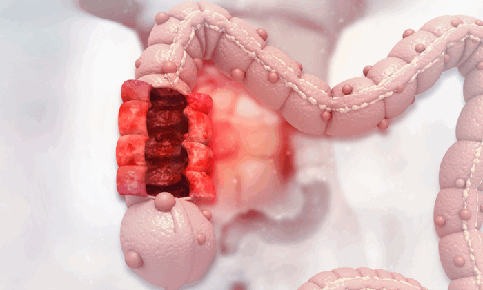 гиперпластический полип желудка