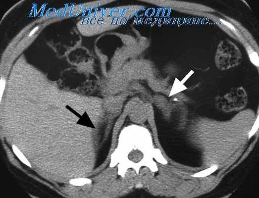 надпочечниковая недостаточность