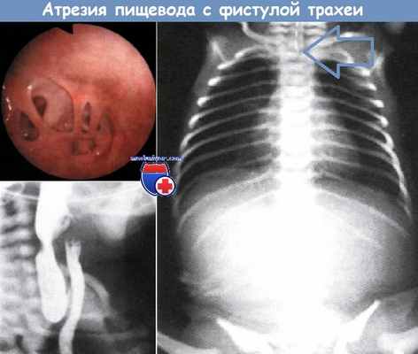 Атрезия пищевода с фистулой трахеи