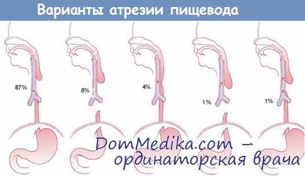 Варианты атрезии пищевода