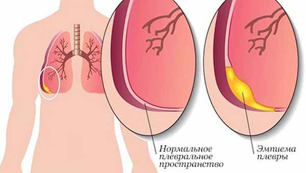 Эмпиема плевры