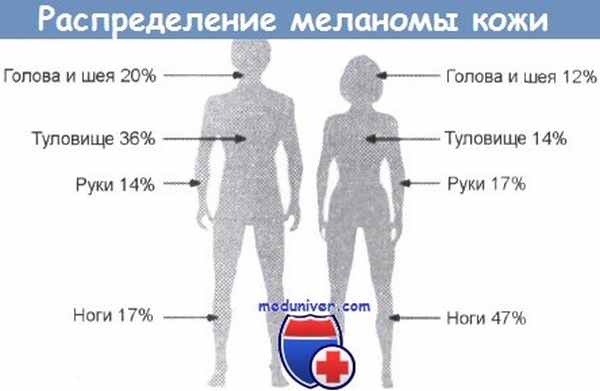 Распределение меланомы кожи