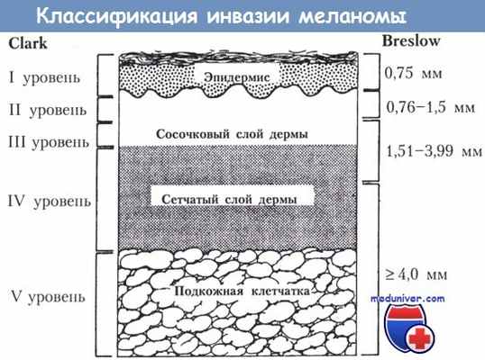 Классификация инвазии меланомы по Clark и Breslow