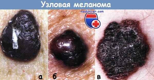 Узловая меланома