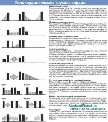 Фонокардиограмма шумов сердца
