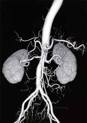 Брюшной отдел аорты
