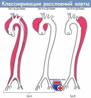 Классификация расслоений аорты