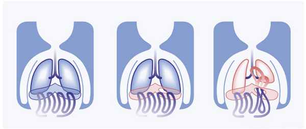 Esquema de la hernia diafragmática congenita