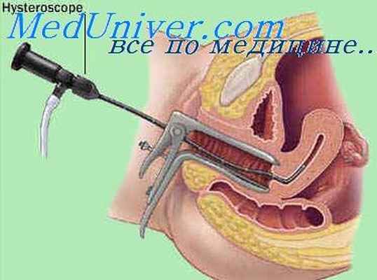 гистероскопия