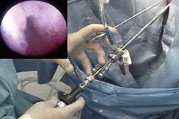 Гистероскопия удаление полипа