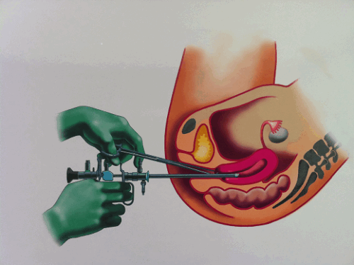 Гистероскопия удаление полипа