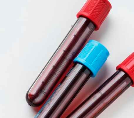 Анализ крови на ВИЧ