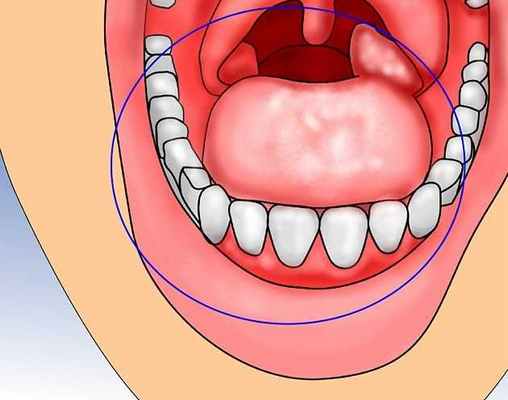 язвы во рту