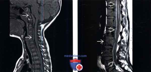 МРТ при субдуральной гематоме позвоночника